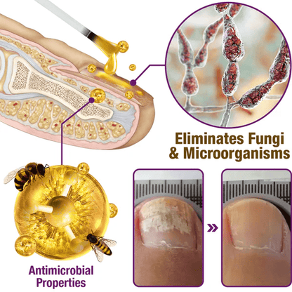 Flysmus - Suero para tratamiento de uñas con veneno de abeja